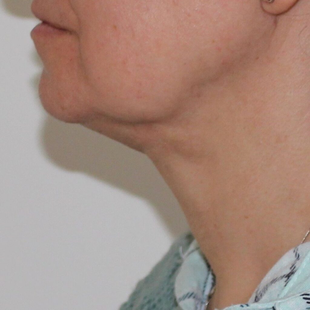 liposuccion de papada 3 despues