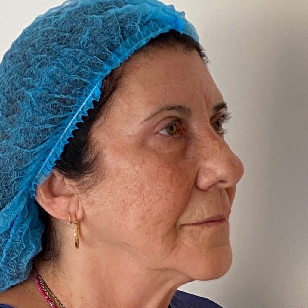 blefaroplastia 9 despues