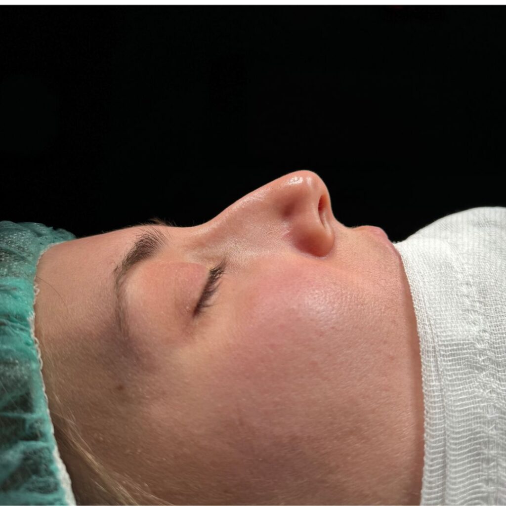 rinoplastia ultrasonica 35 antes