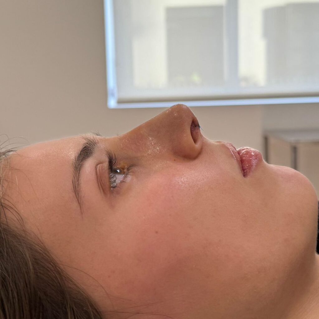 rinoplastia ultrasonica 35 despues