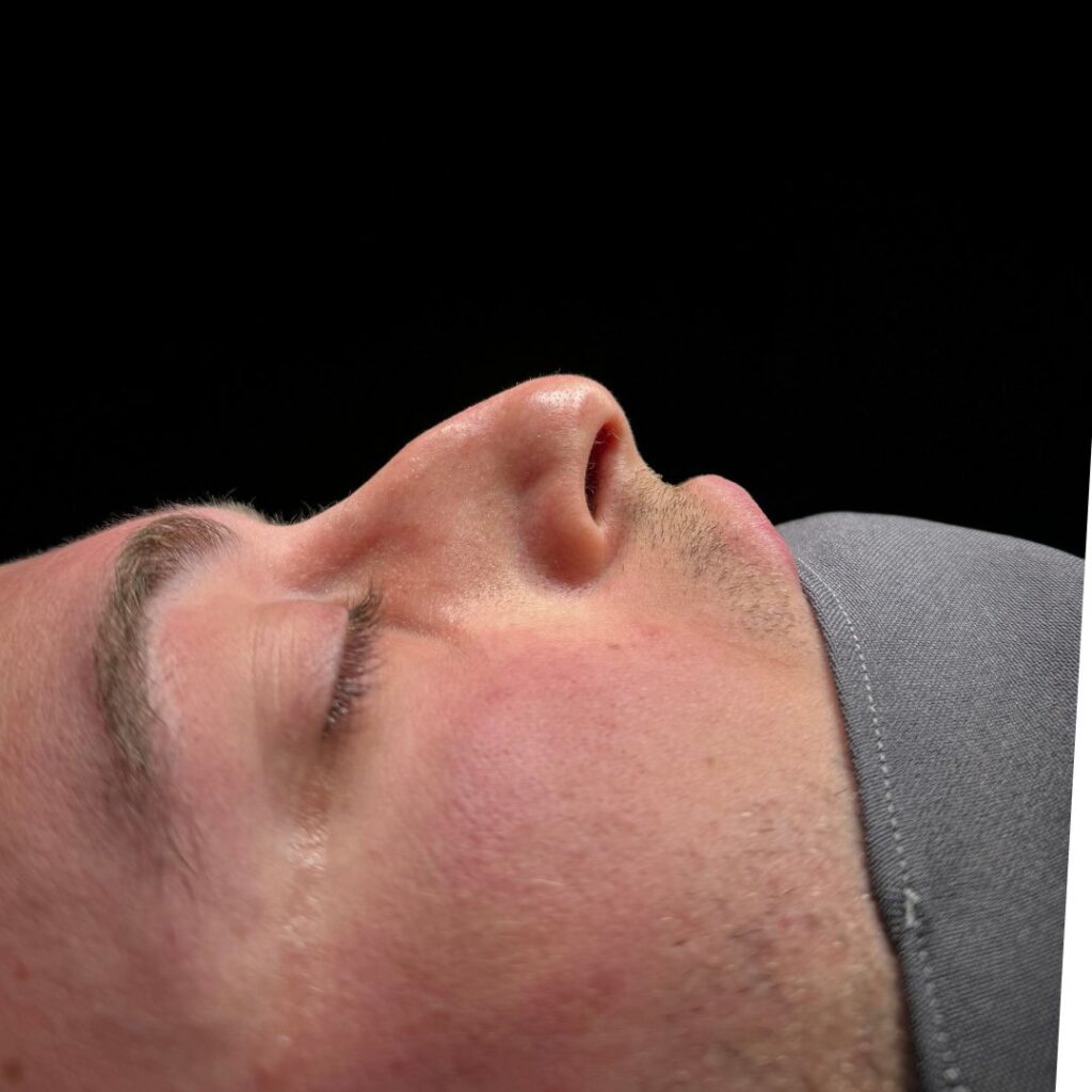 rinoplastia ultrasonica 37 antes