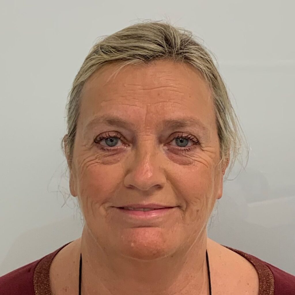 blefaroplastia 10 antes