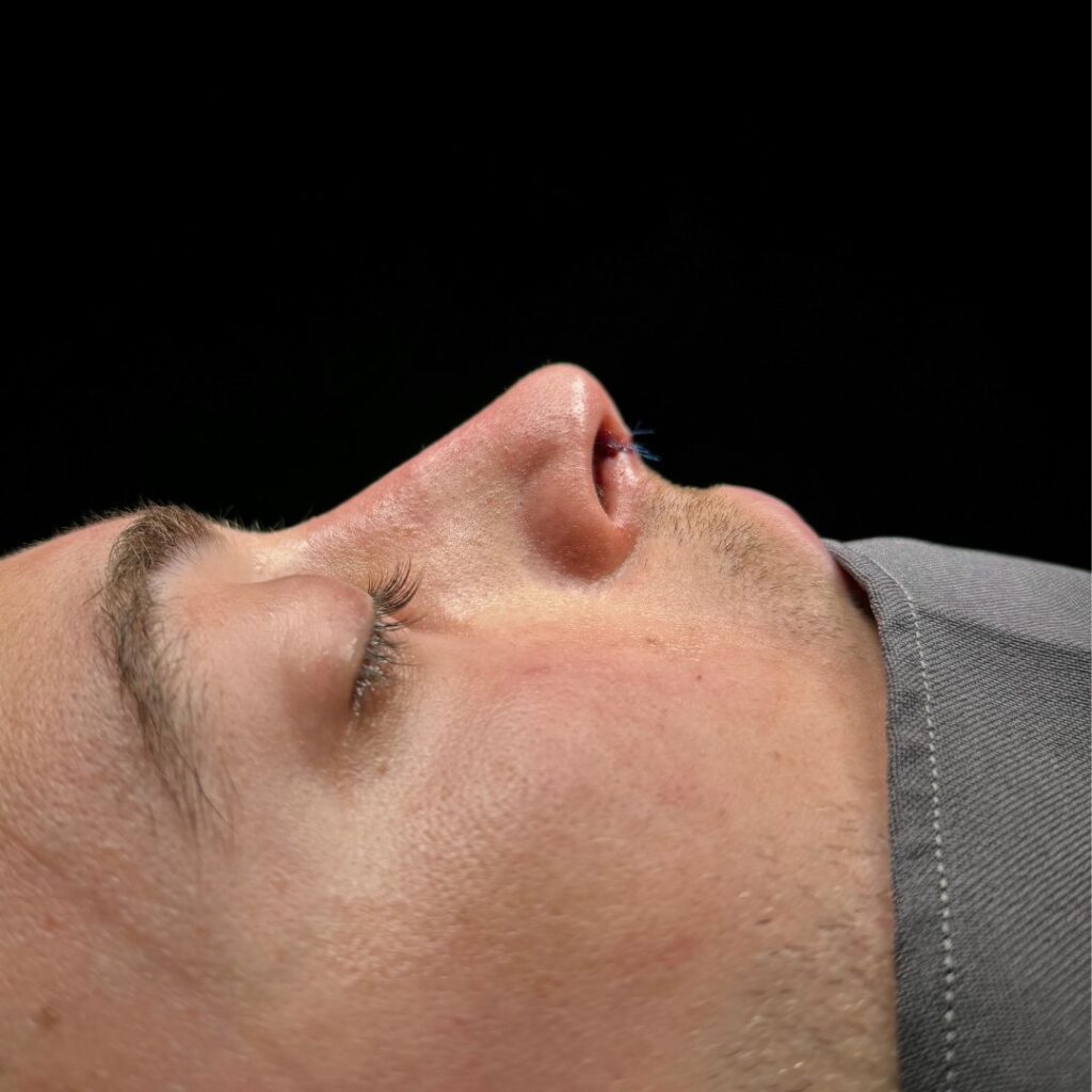 rinoplastia ultrasonica 37 despues