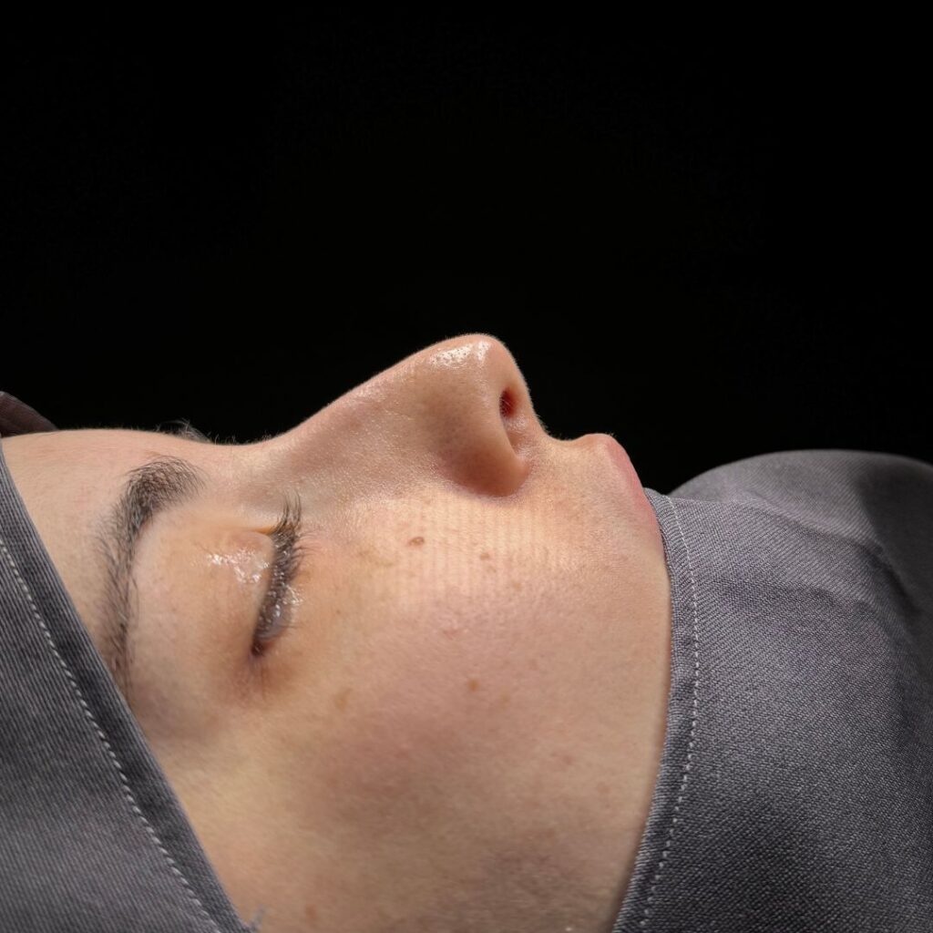 rinoplastia ultrasonica 38 antes