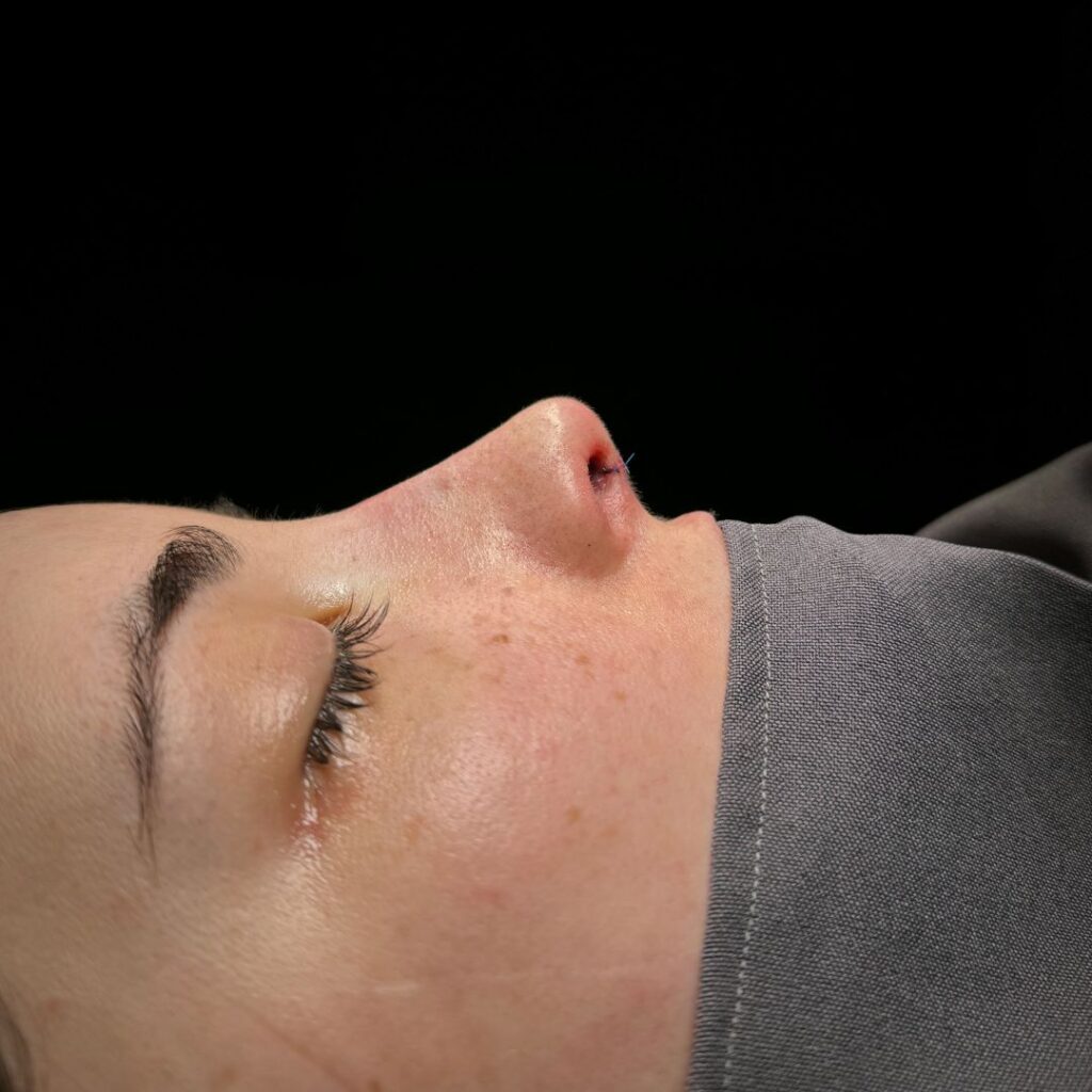 rinoplastia ultrasonica 38 despues