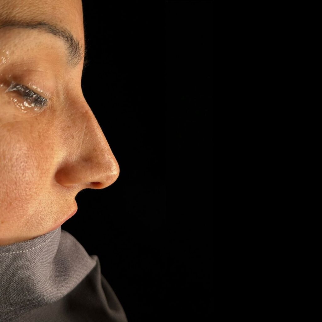 rinoplastia ultrasonica 43 antes