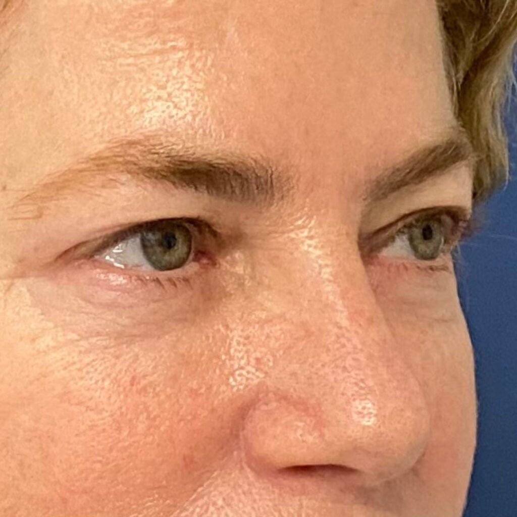 blefaroplastia 10A antes