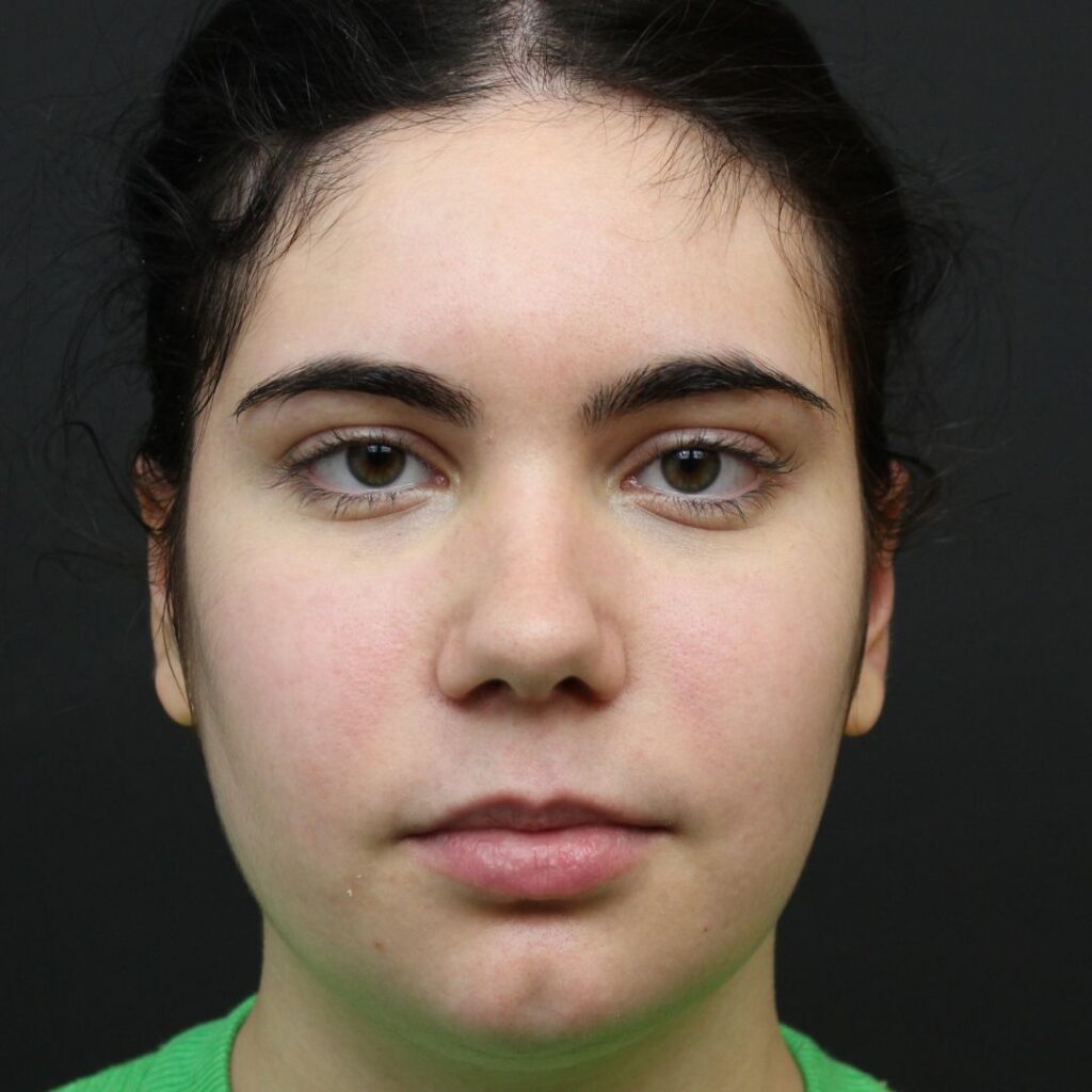 otoplastia 4 despues