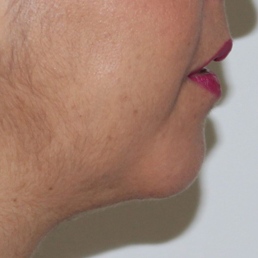 mentoplastia 3 despues