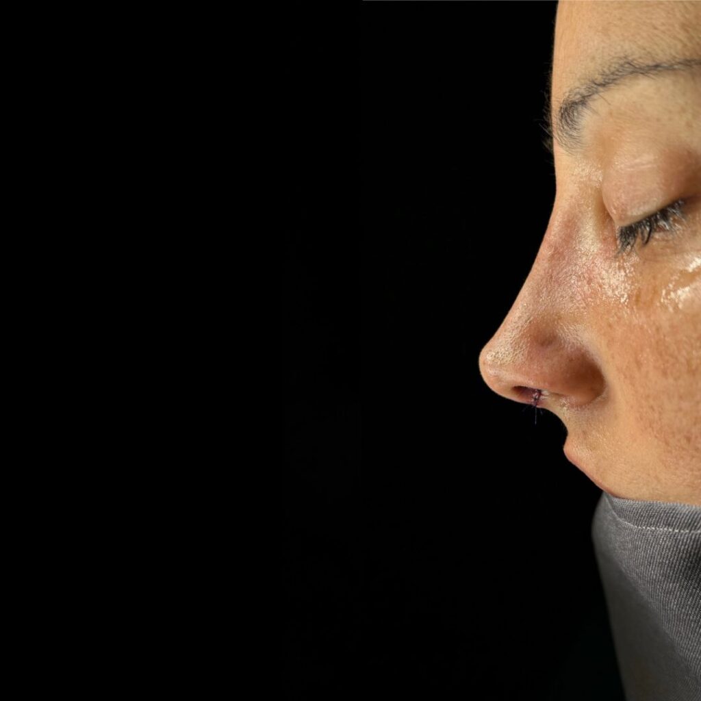 rinoplastia ultrasonica 43 despues