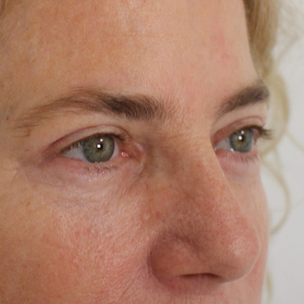 blefaroplastia 10A despues