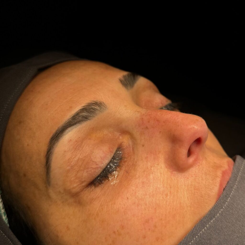 rinoplastia ultrasonica 46 antes