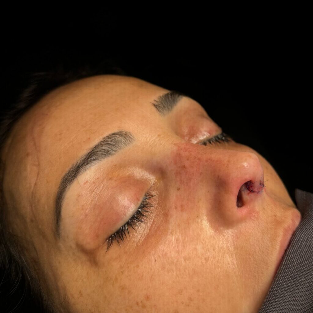 rinoplastia ultrasonica 46 despues
