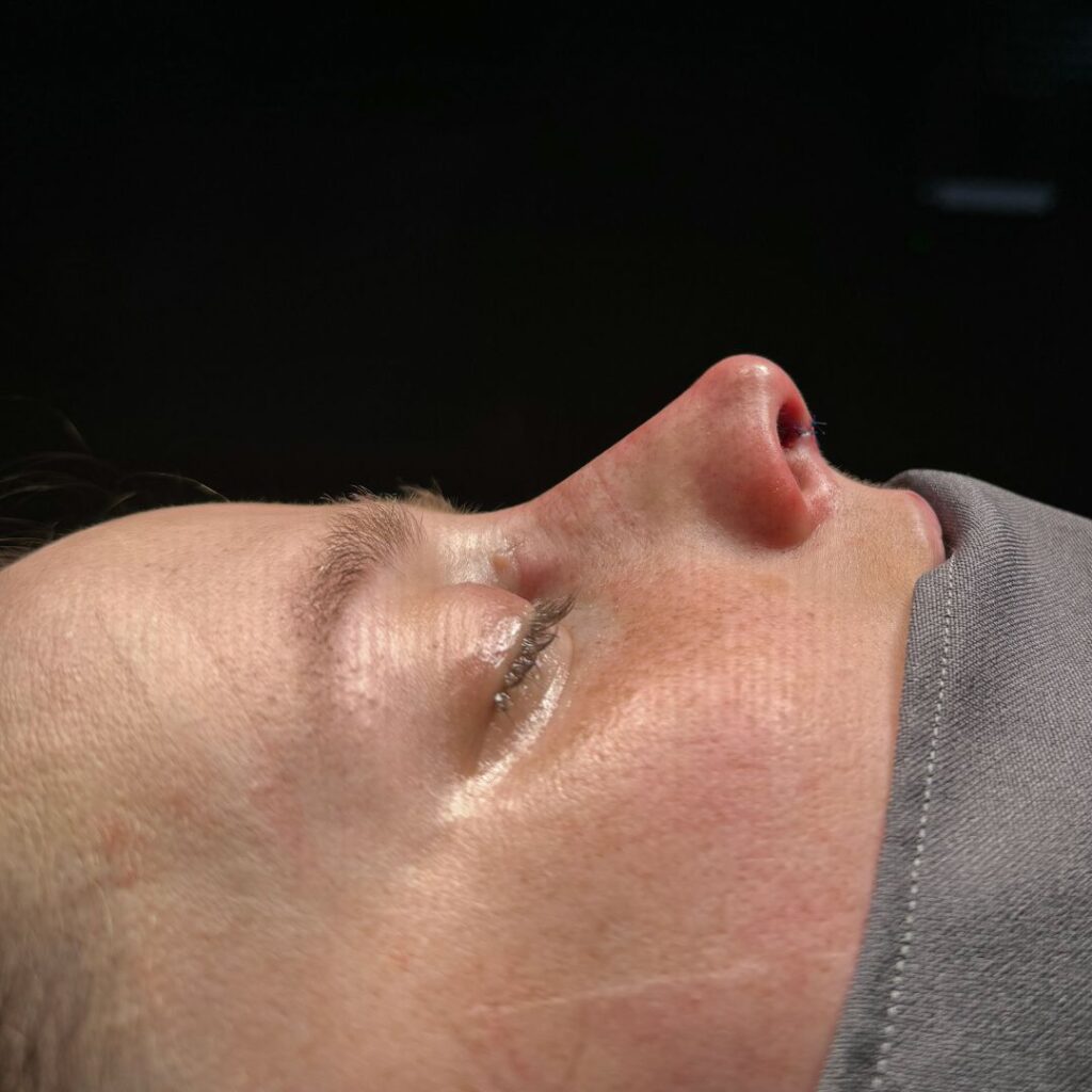 rinoplastia ultrasonica 47 despues