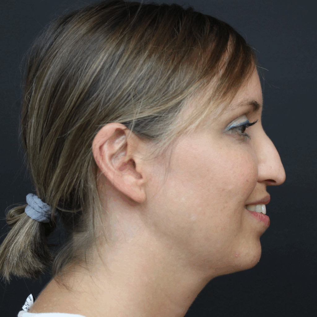 rinoplastia ultrasonica 53 antes