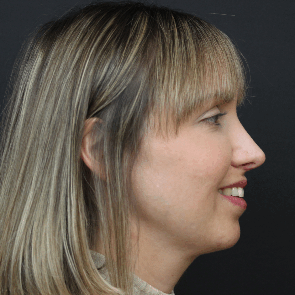 rinoplastia ultrasonica 53 despues