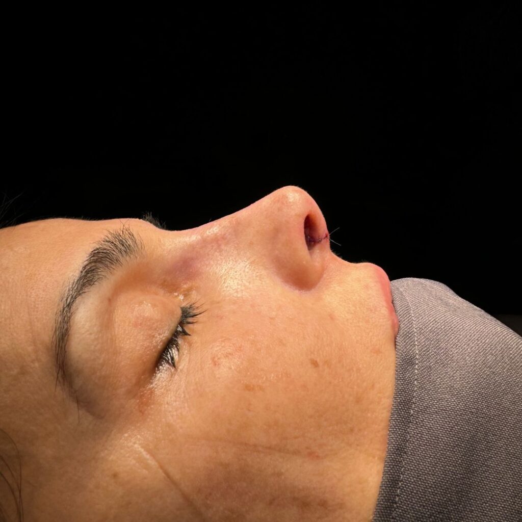 rinoplastia ultrasonica 55 despues