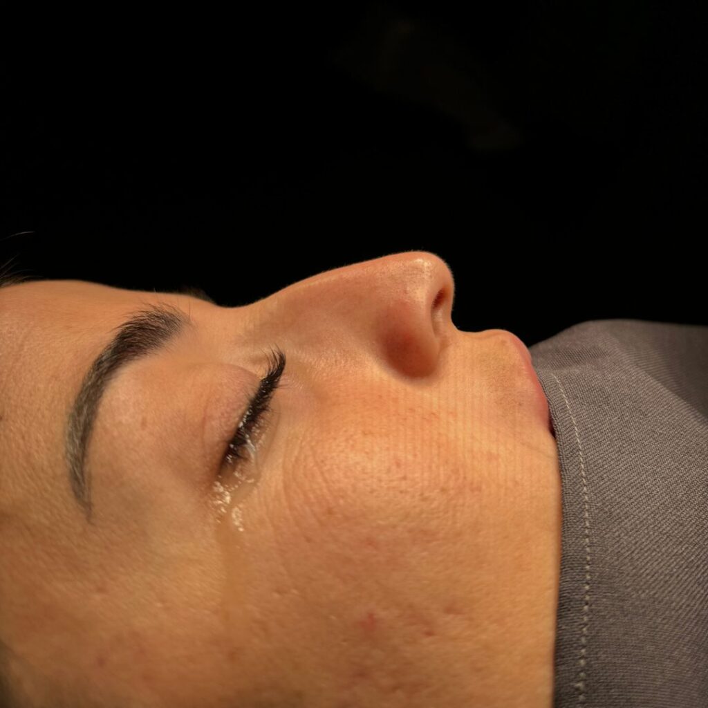 rinoplastia ultrasonica 56 antes