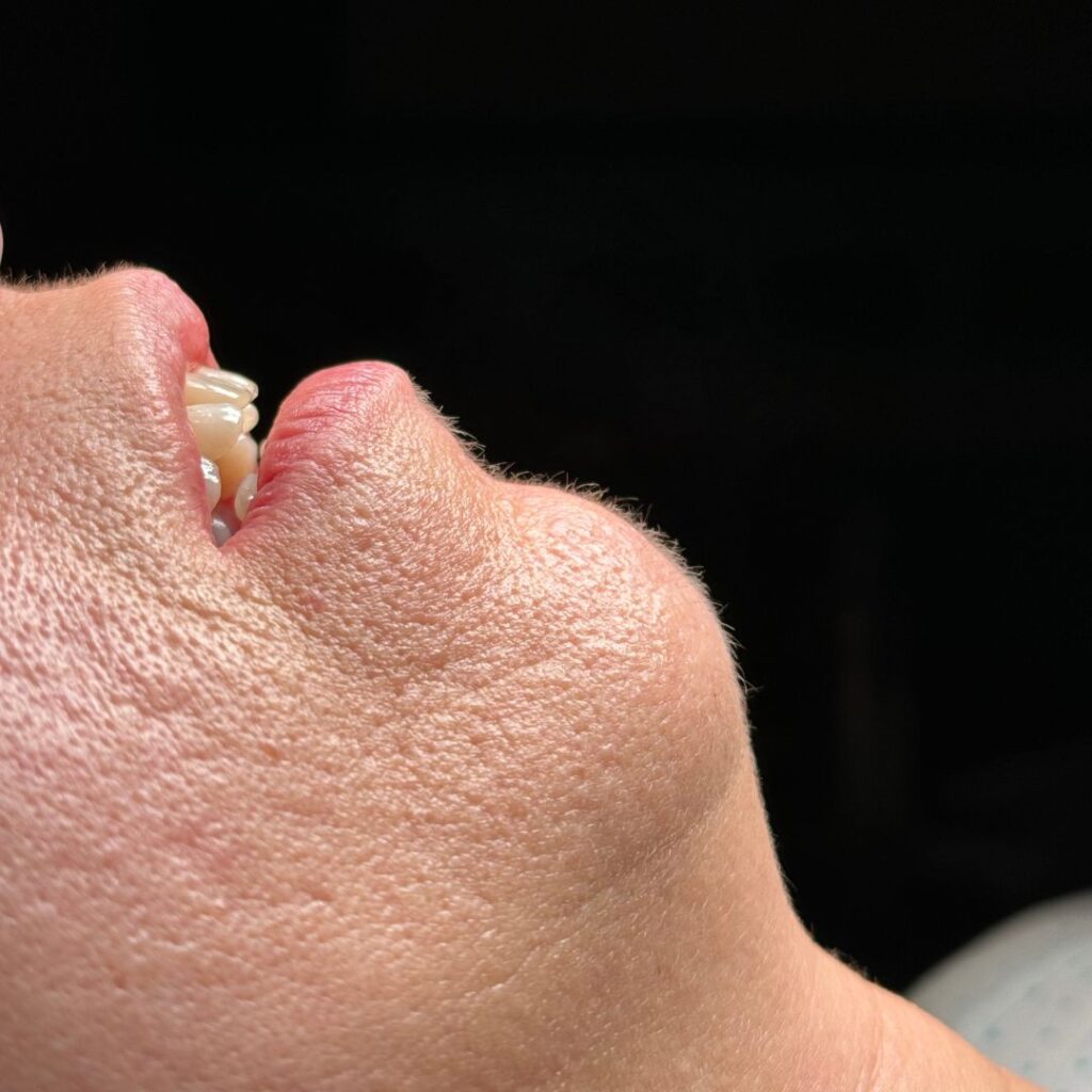 mentoplastia 4 antes