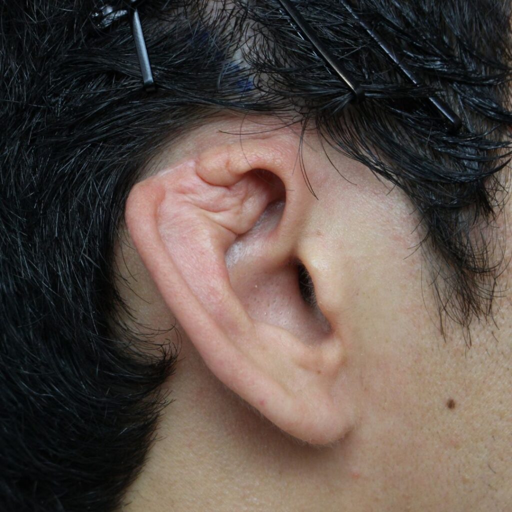 reconstruccion auricular