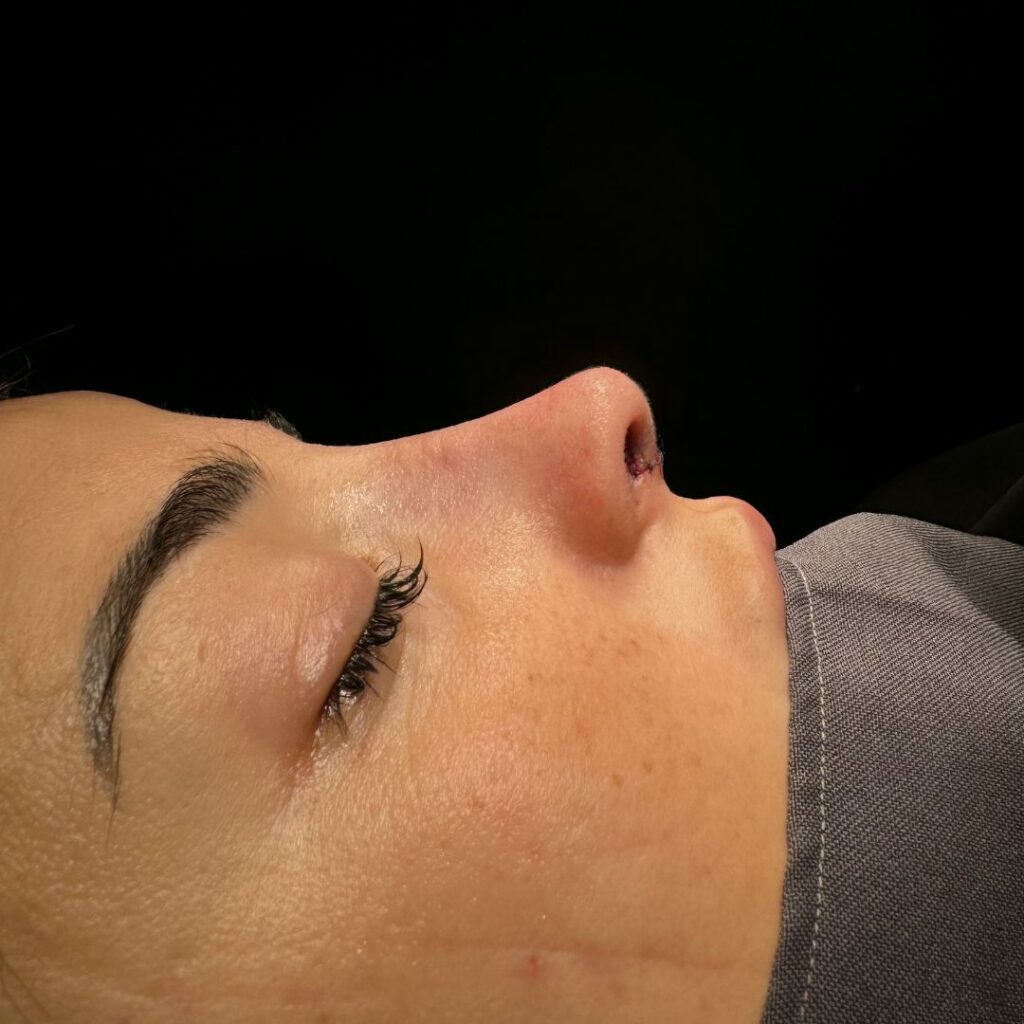 rinoplastia ultrasonica 56 despues