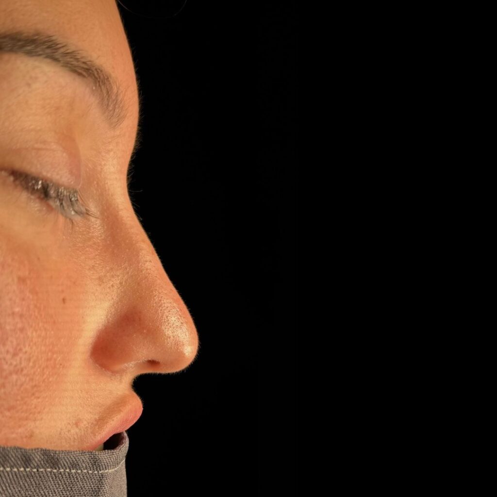 rinoplastia ultrasonica 59 antes