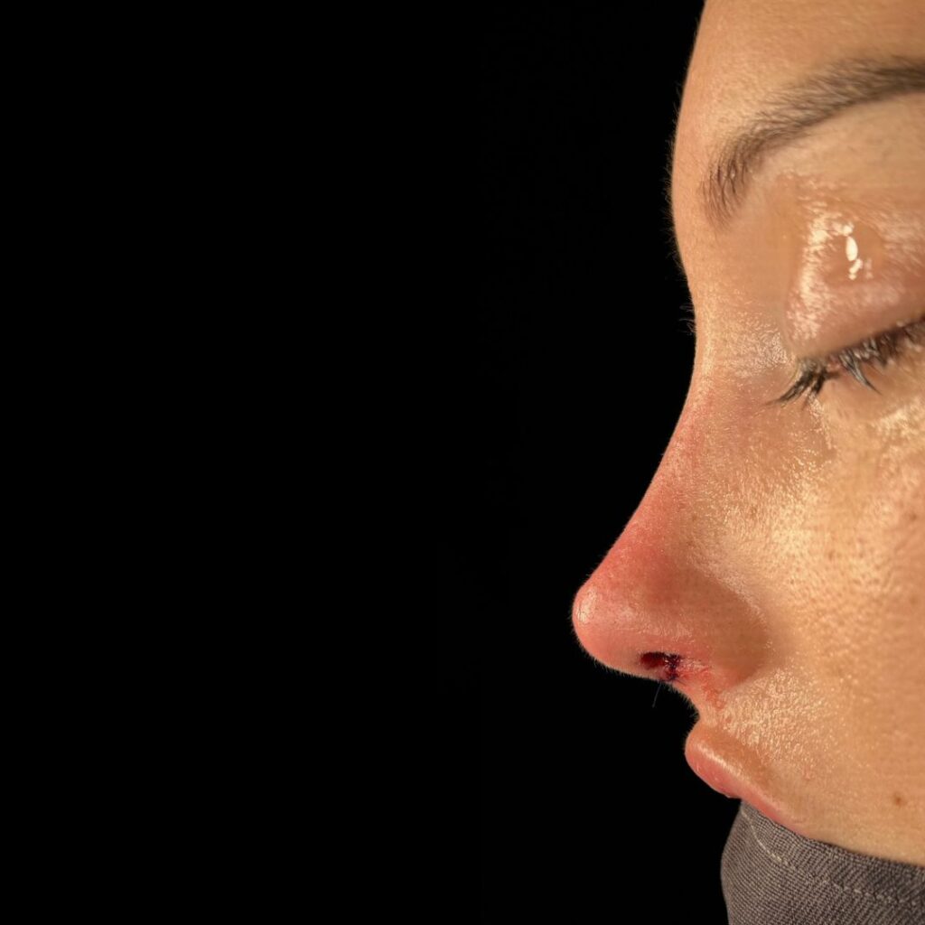 rinoplastia ultrasonica 59 despues