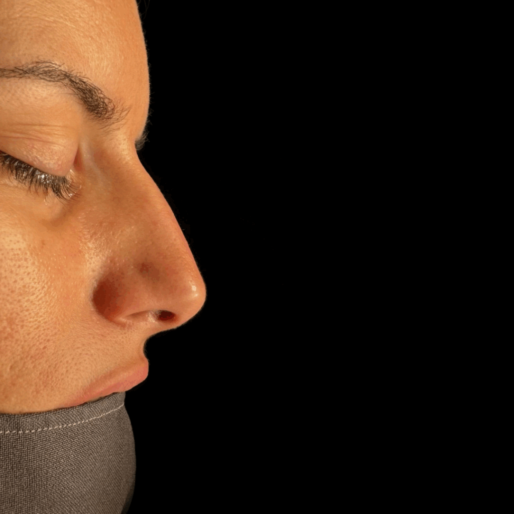 rinoplastia ultrasonica 60 antes