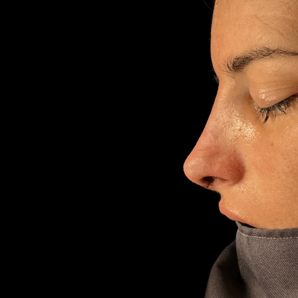 rinoplastia ultrasonica 60 despues