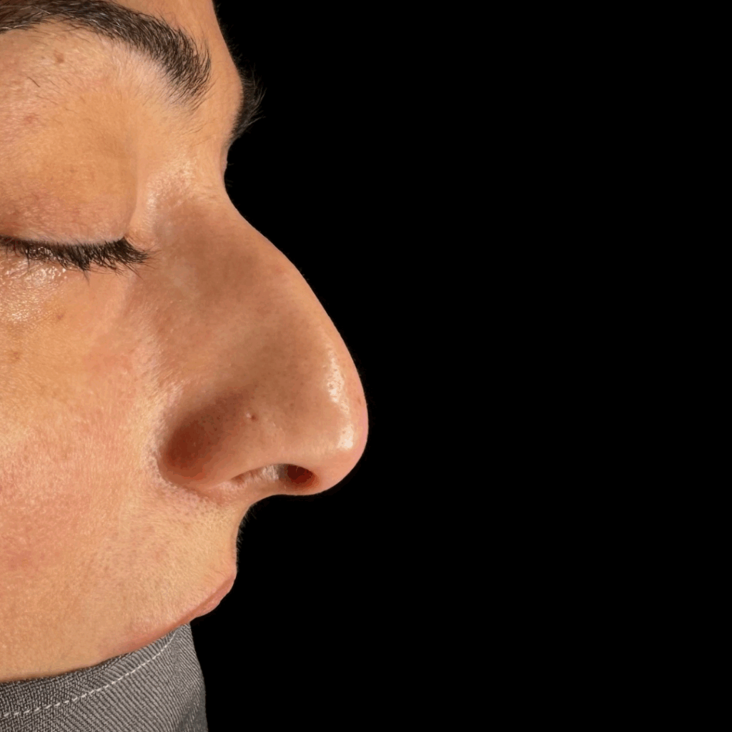 rinoplastia ultrasonica 61 antes