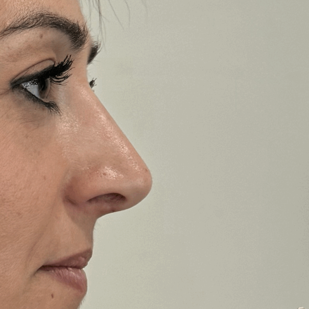 rinoplastia ultrasonica 61 despues