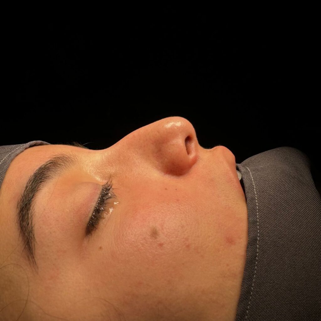 rinoplastia ultrasonica 64 antes