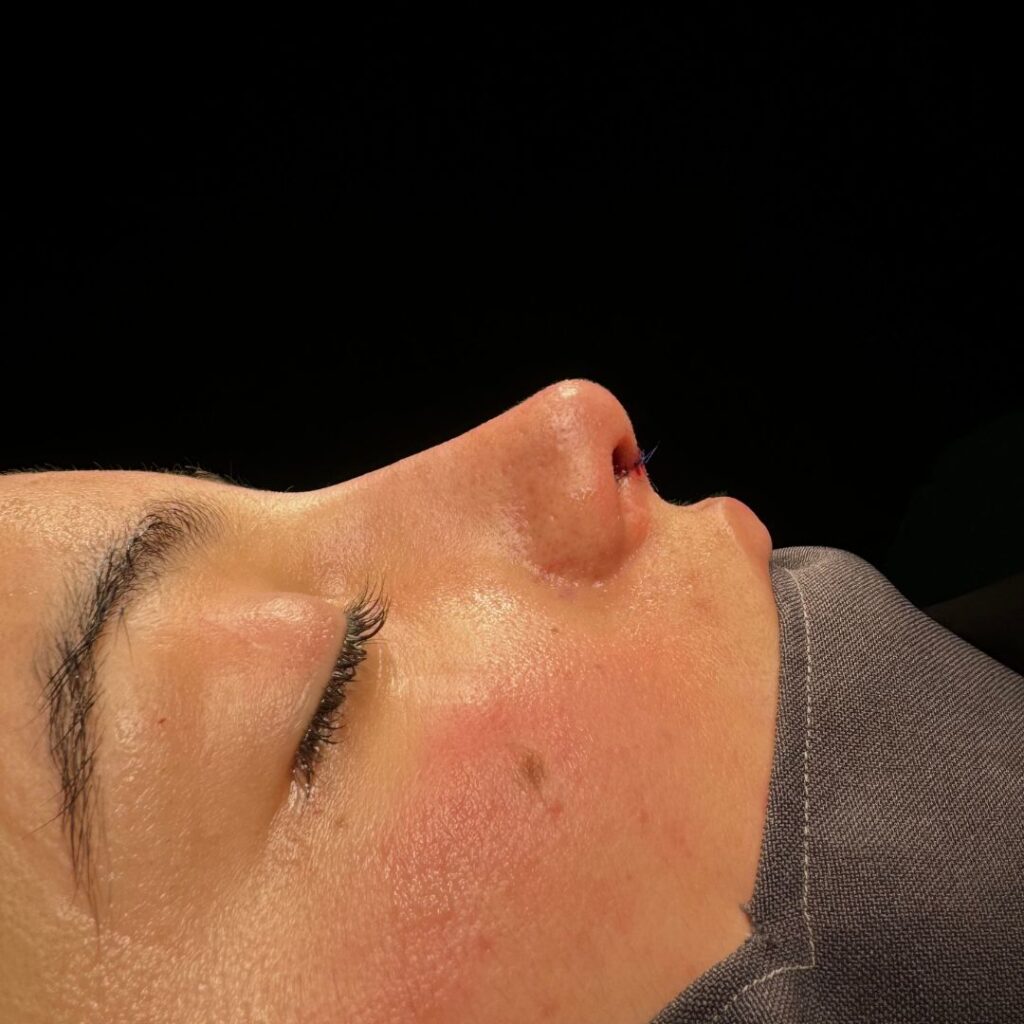 rinoplastia ultrasonica 64 despues