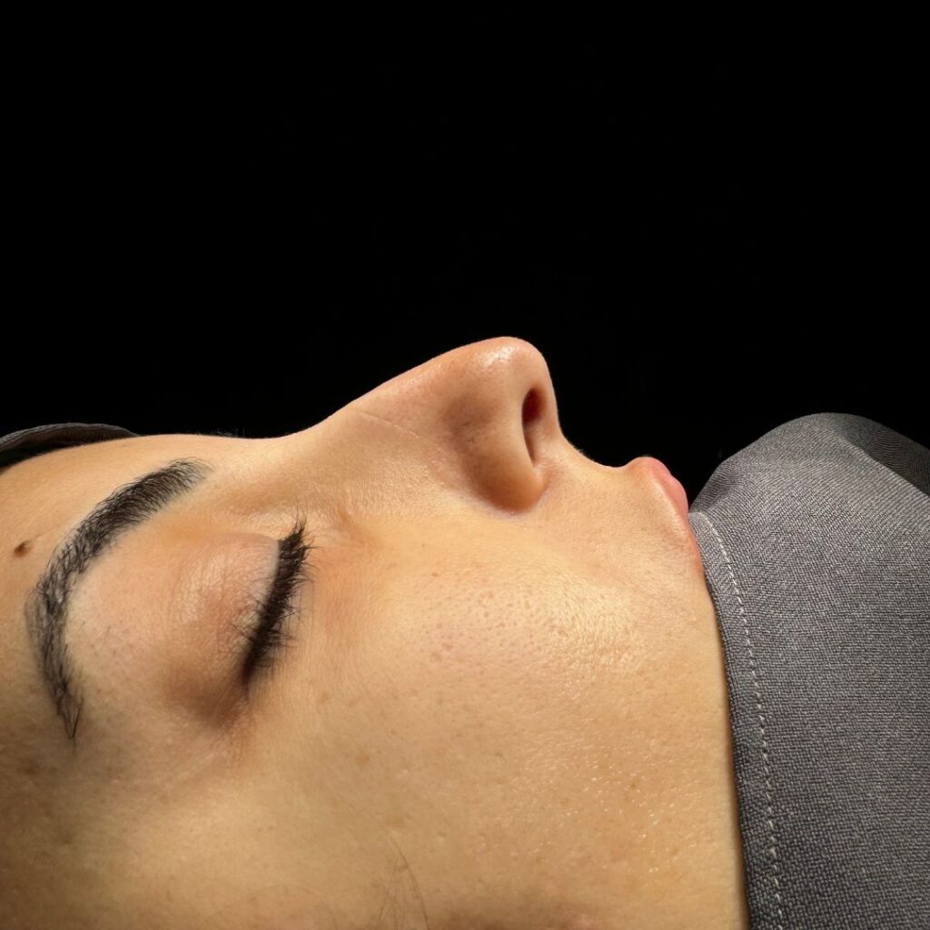 rinoplastia ultrasonica 63 antes