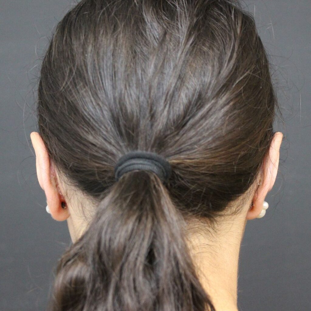 otoplastia 5 despues