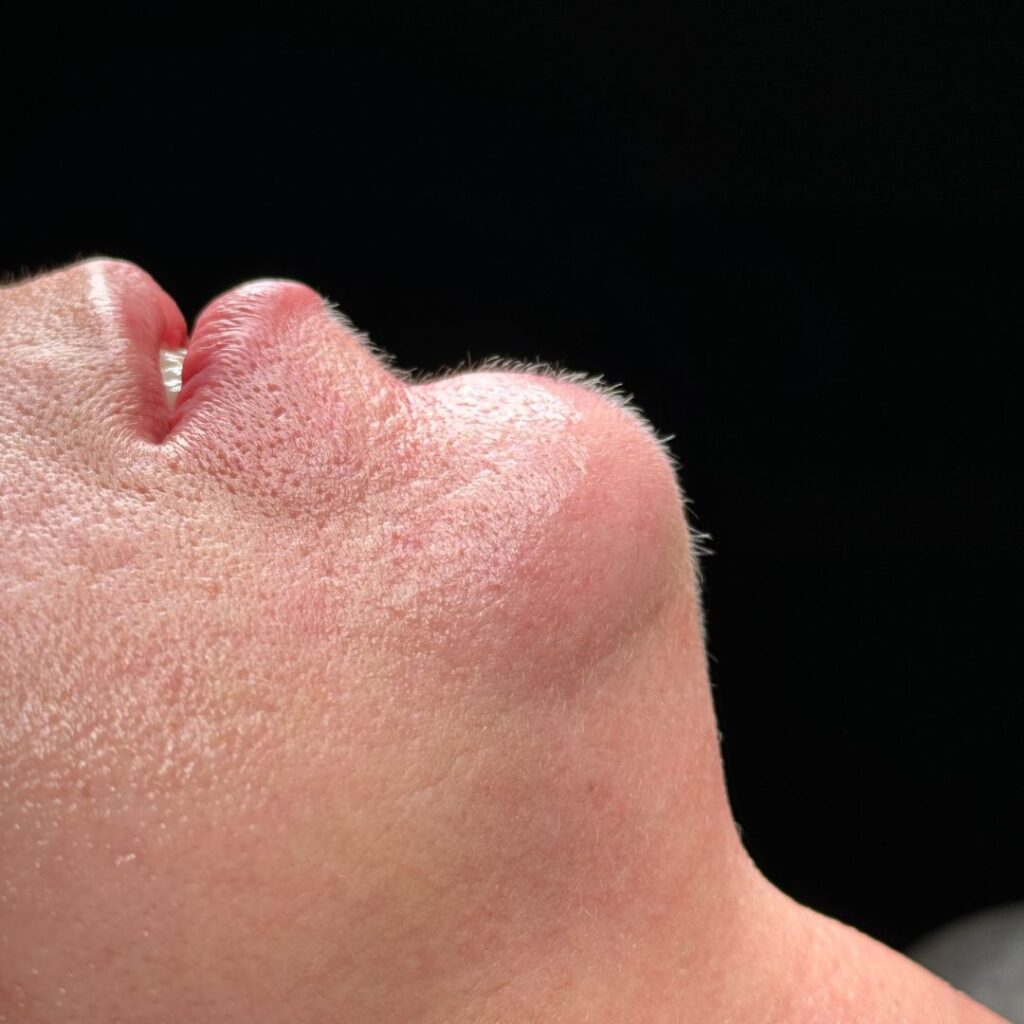 mentoplastia 4 despues