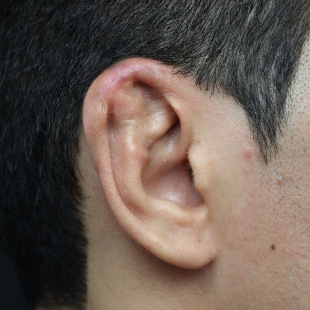 reconstruccion auricular despues