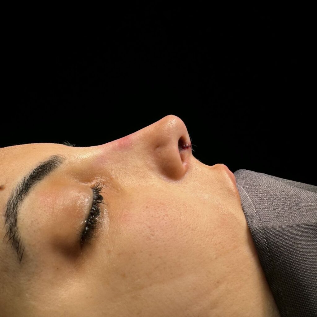 rinoplastia ultrasonica 63 despues