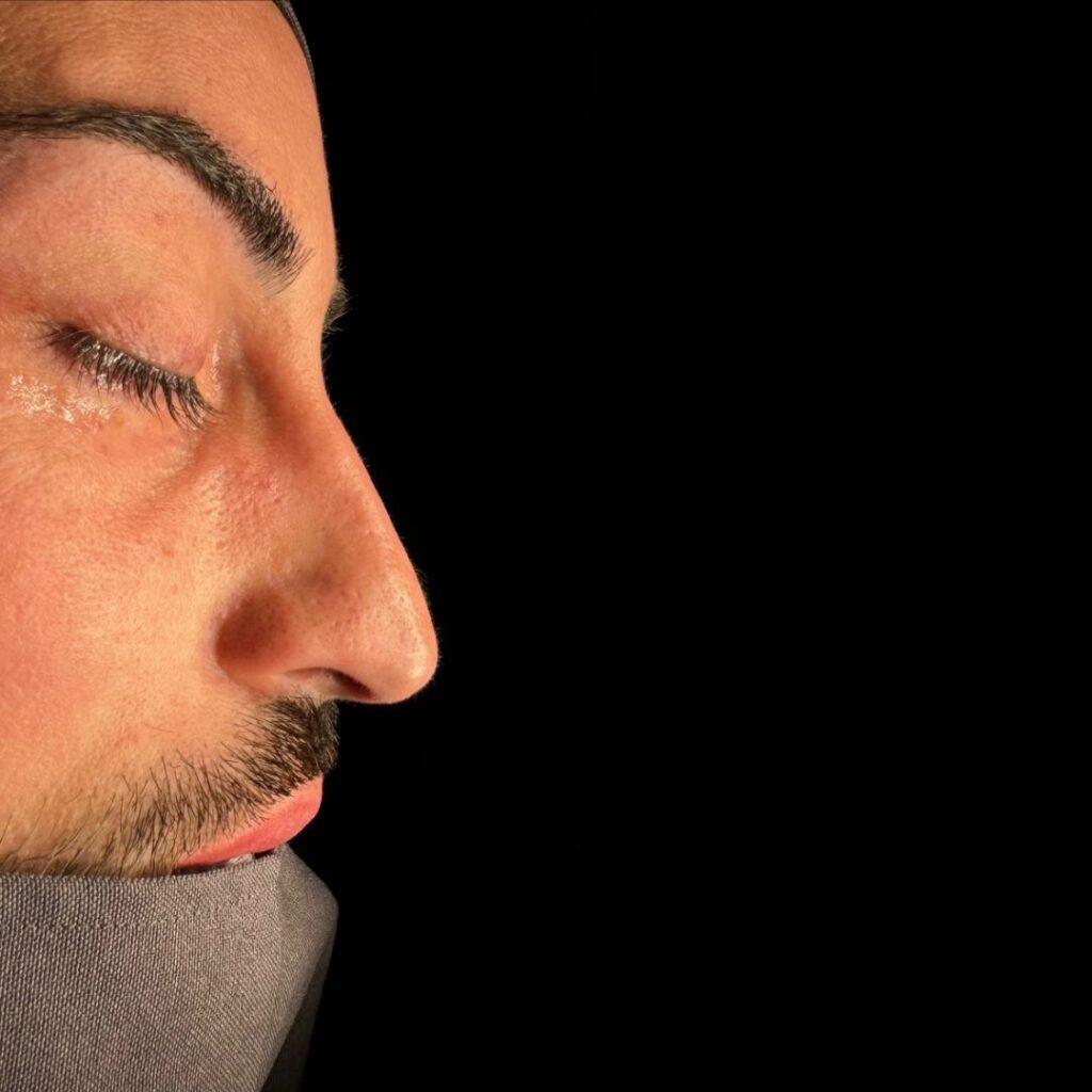 rinoplastia ultrasonica 67 antes