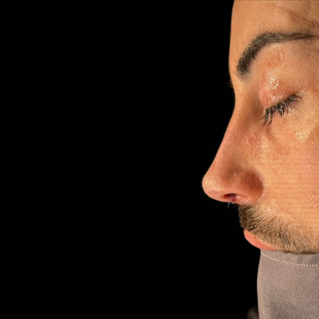 rinoplastia ultrasonica 67 despues