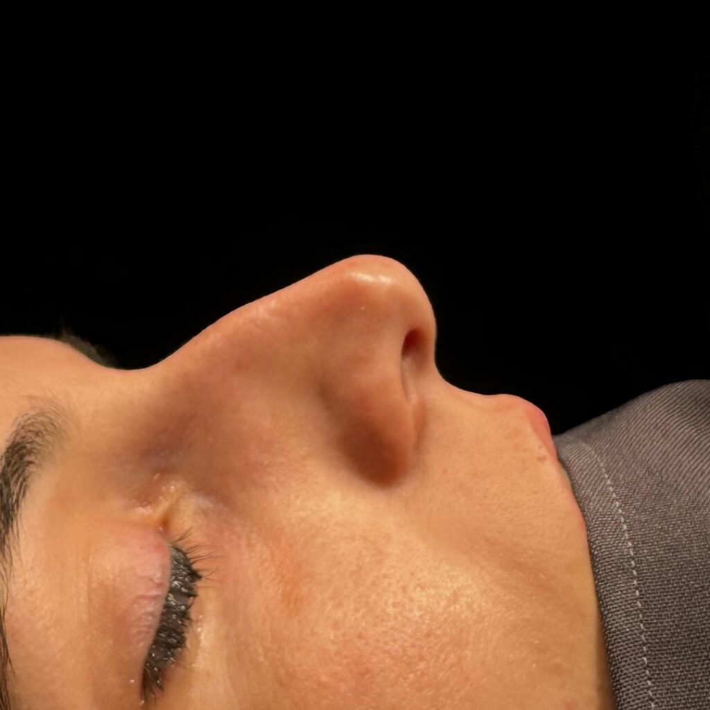 rinoplastia ultrasonica 66 antes