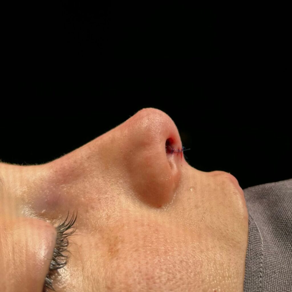 rinoplastia ultrasonica 66 despues