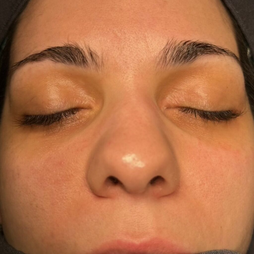 rinoplastia ultrasonica 69 antes