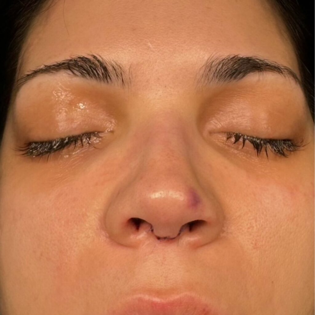 rinoplastia ultrasonica 69 despues
