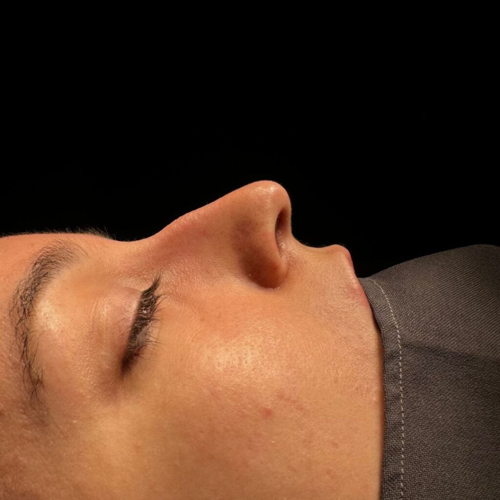 rinoplastia ultrasonica 68 antes