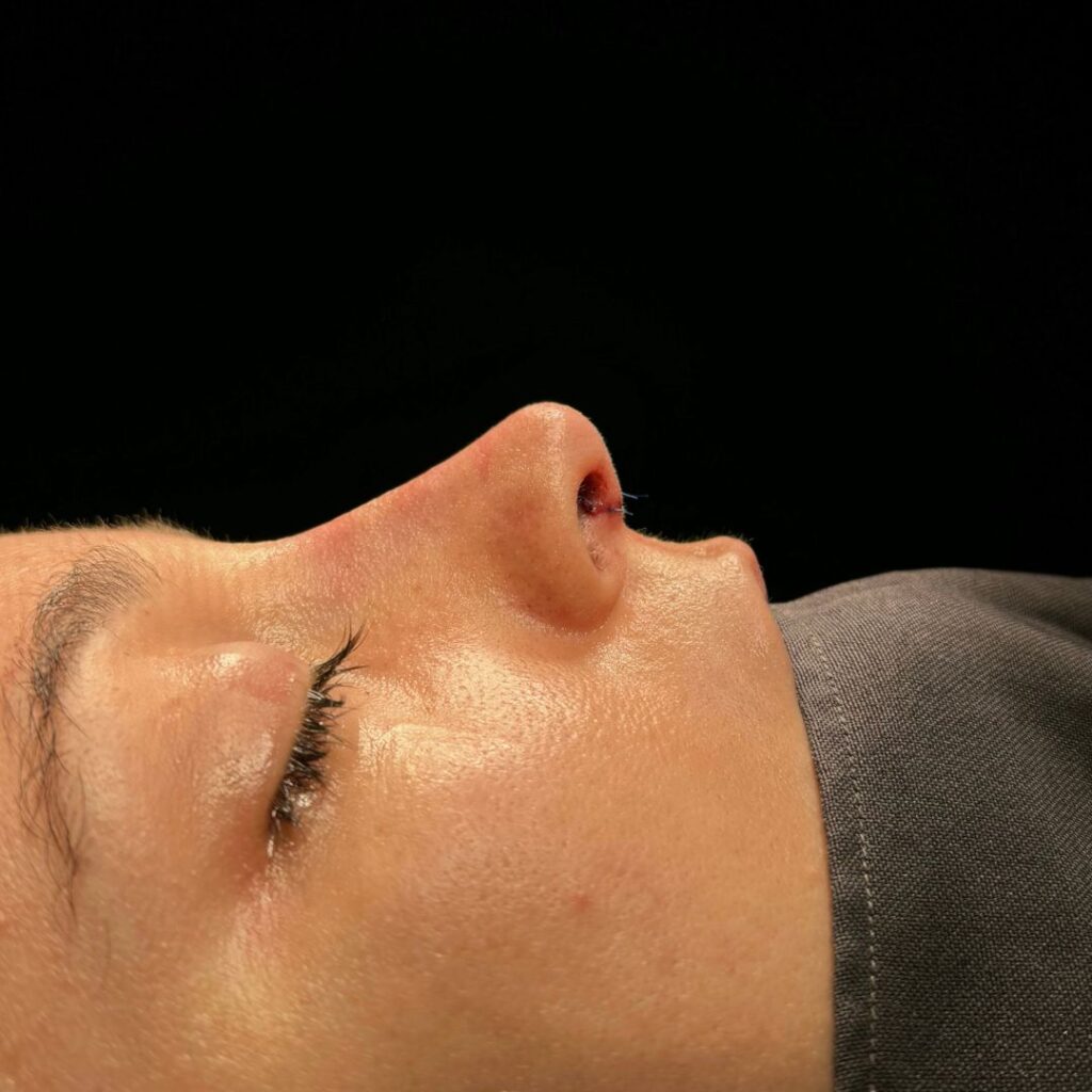 rinoplastia ultrasonica 68 despues