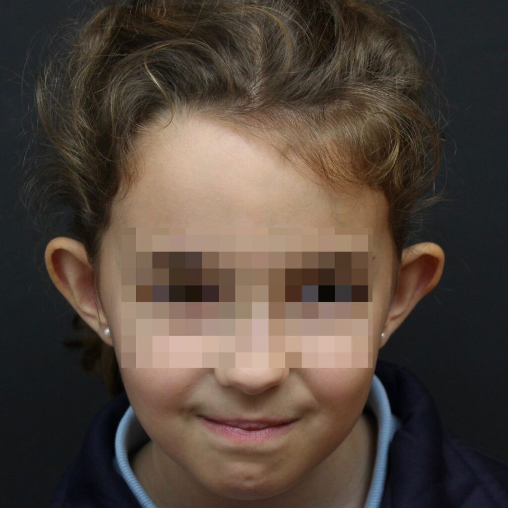 otoplastia 6 antes