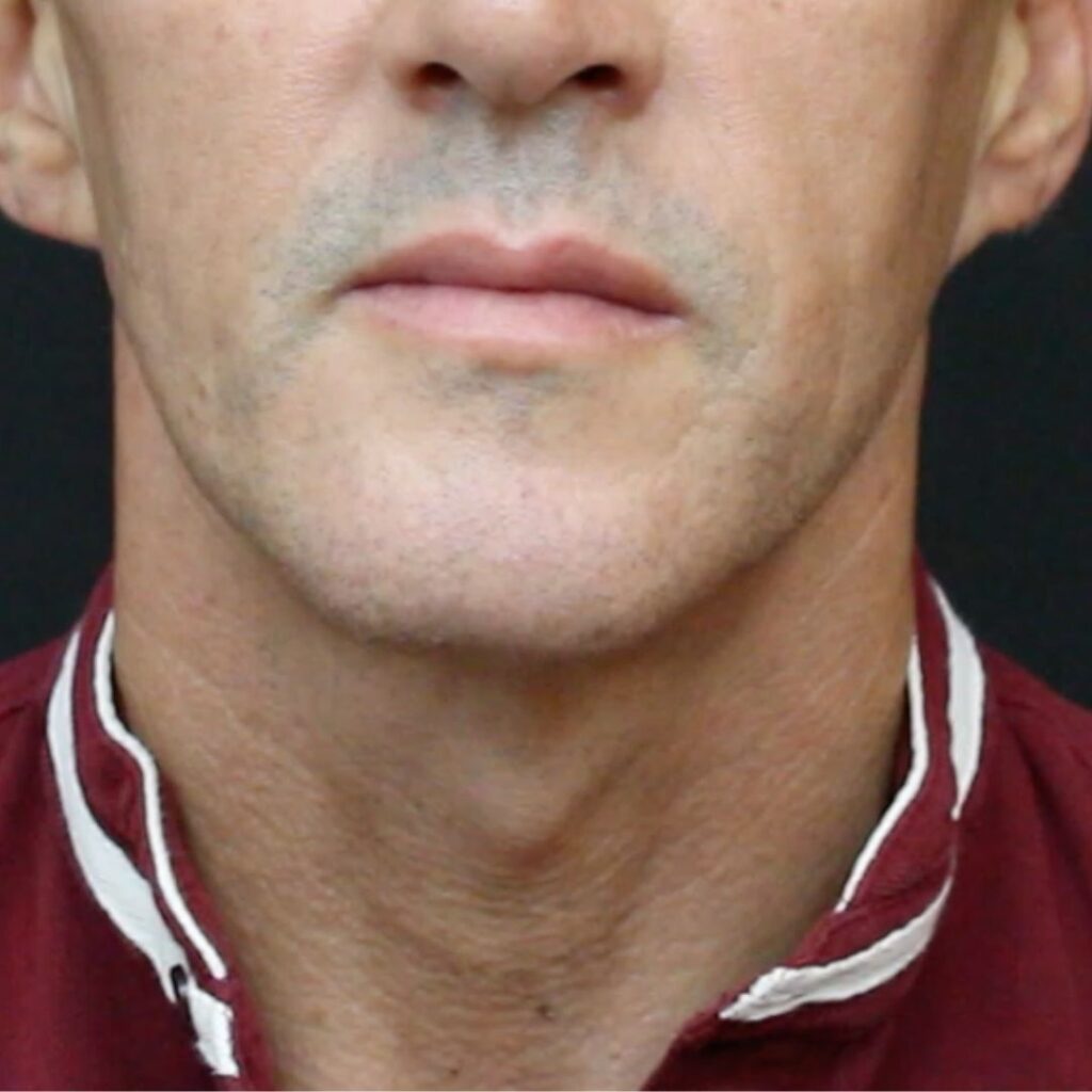 masculinizacion-facial