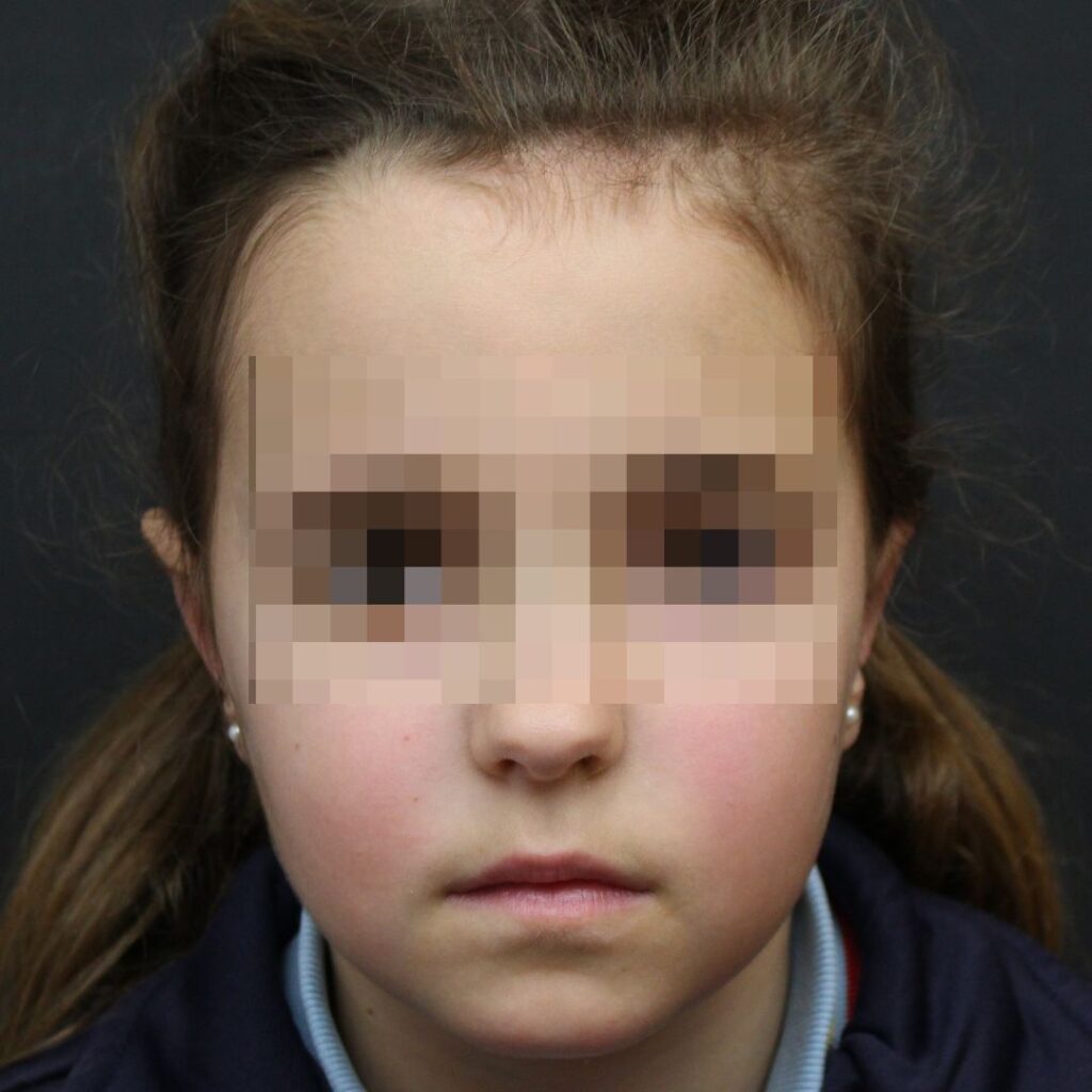 otoplastia 6 despues