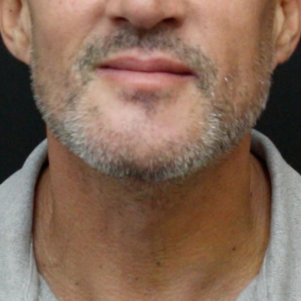 masculinizacion-facial-despues